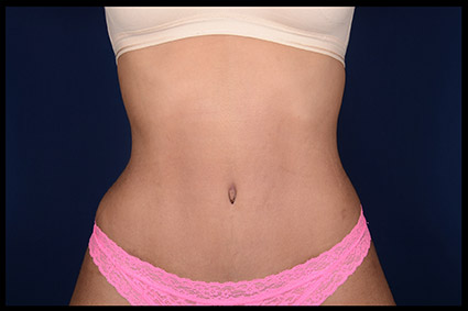 5 Facts About Hanging Belly After Child birth - Cosmetic Surgeon
