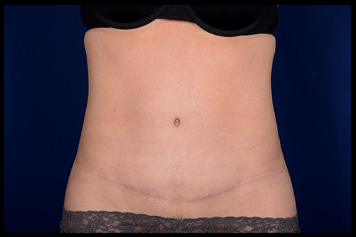 How Long Does It Take for Tummy Tuck Scars to Heal?